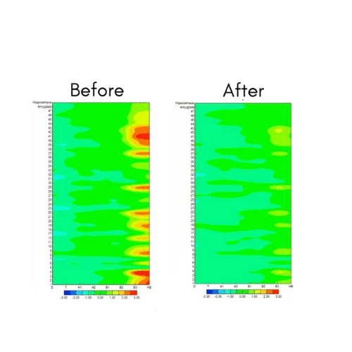 Brain Waves After Taking Anxiety Aide For Anxiety Relief